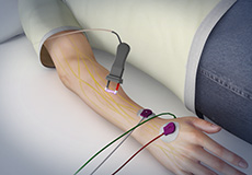 EMG and Nerve Conduction Studies