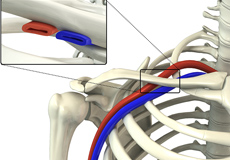 Thoracic Outlet Syndrome